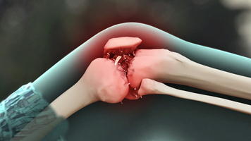 Osteoartritis